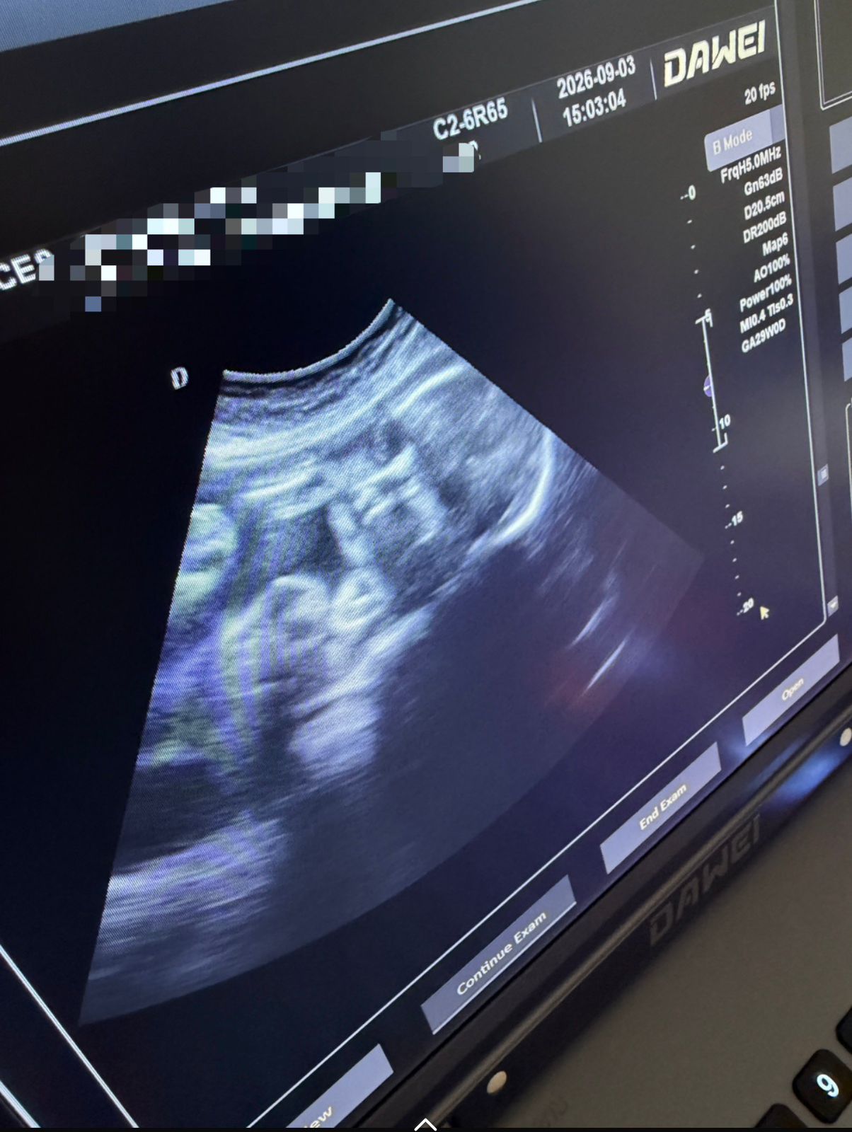 Close-up of an obstetric ultrasound scan on the new SisterB sonar machine screen